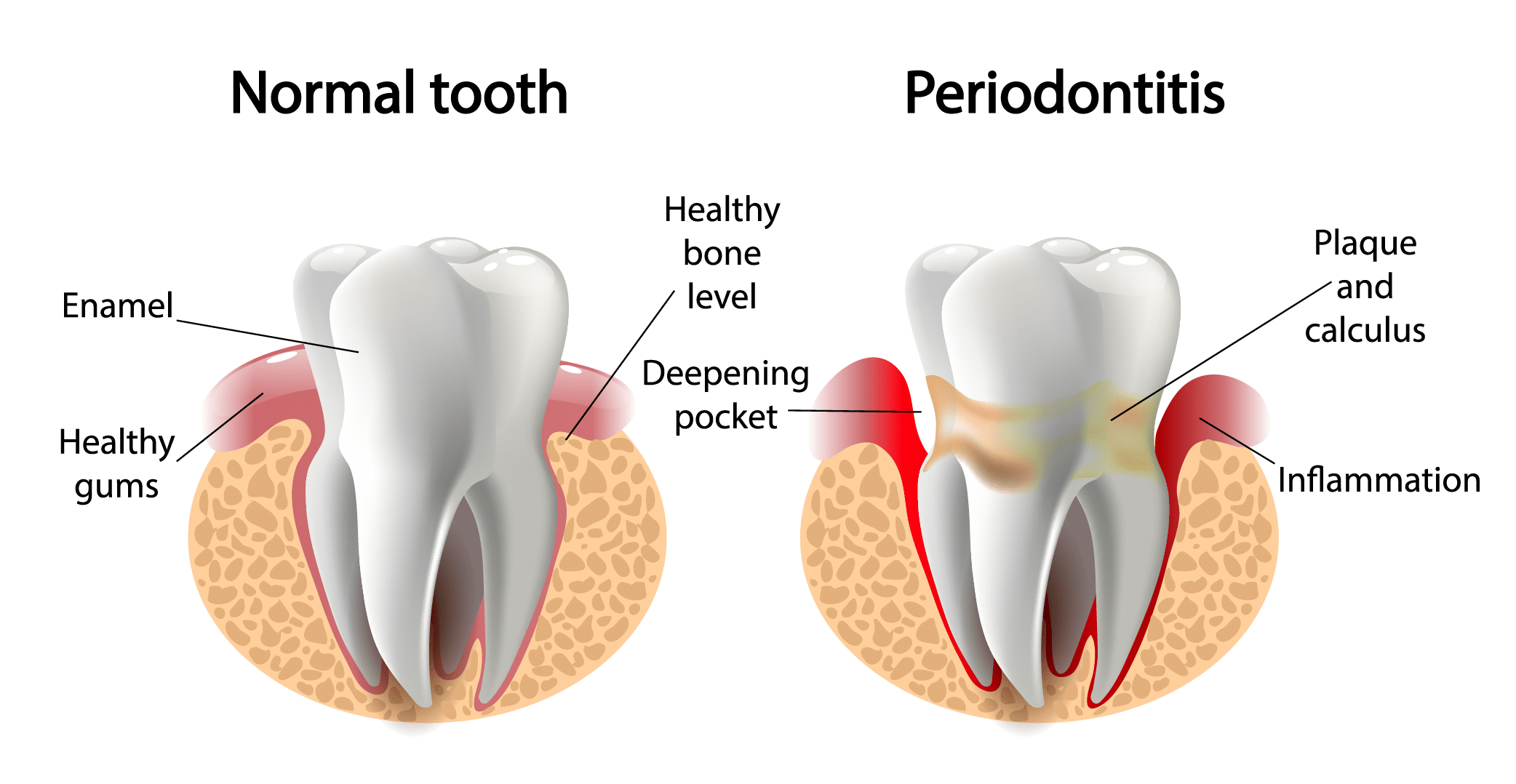 111Periodontal Disease Graphic