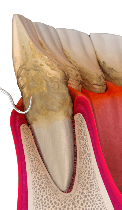 58periodontal disease