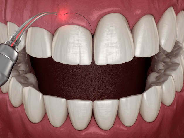 61Crownlengthening