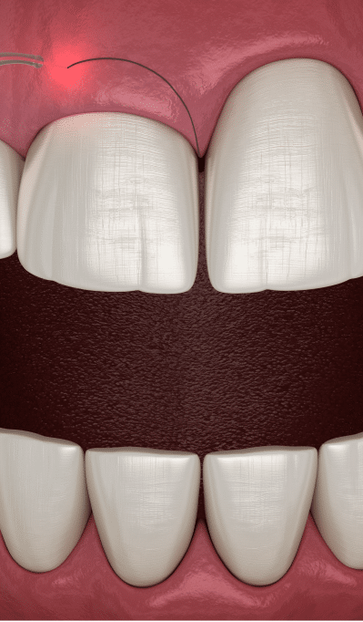 63CrownLengthening