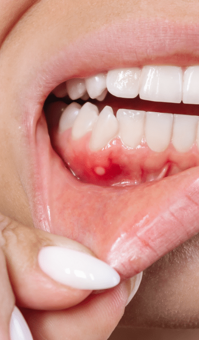 63GumBiopsy